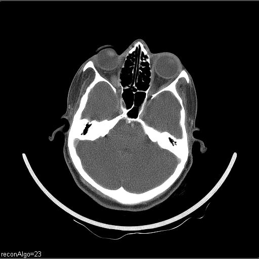 Carcinoma of the maxillary antrum (Radiopaedia 53805-59888 Axial C+ delayed 64).jpg