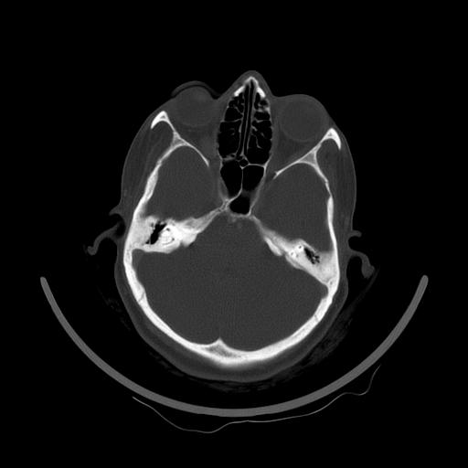 Carcinoma of the maxillary antrum (Radiopaedia 53805-59888 Axial bone window 26).jpg