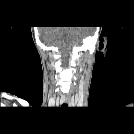 Carcinoma of the maxillary antrum (Radiopaedia 53805-59888 Coronal C+ delayed 115).jpg
