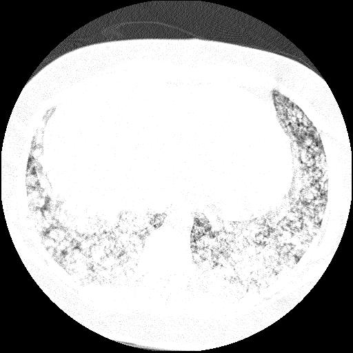 Cardiac angiosarcoma (Radiopaedia 66010-75181 Axial lung window 12).jpg