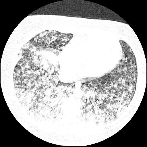 Cardiac angiosarcoma (Radiopaedia 66010-75181 Axial lung window 25).jpg