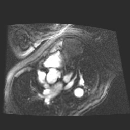 File:Cardiac fibroma (Radiopaedia 38974-41150 4 chamber FGRET 4).jpg
