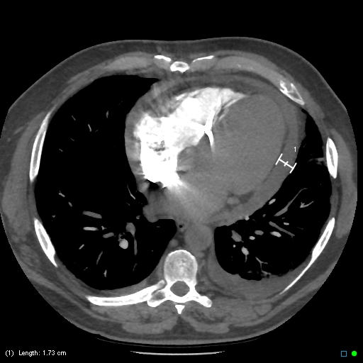 File:Cardiac tamponade (Radiopaedia 20909-20841 B 1).jpg