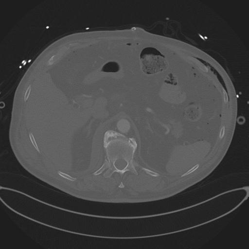 Cardiac trauma (Radiopaedia 32874-33858 Axial bone window 91).jpg