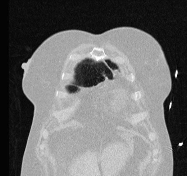 Cardiogenic pulmonary edema (Radiopaedia 29213-29609 Coronal lung window 6).jpg