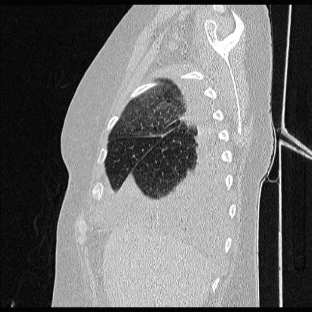 Cardiogenic pulmonary edema (Radiopaedia 29213-29609 Sagittal lung window 17).jpg