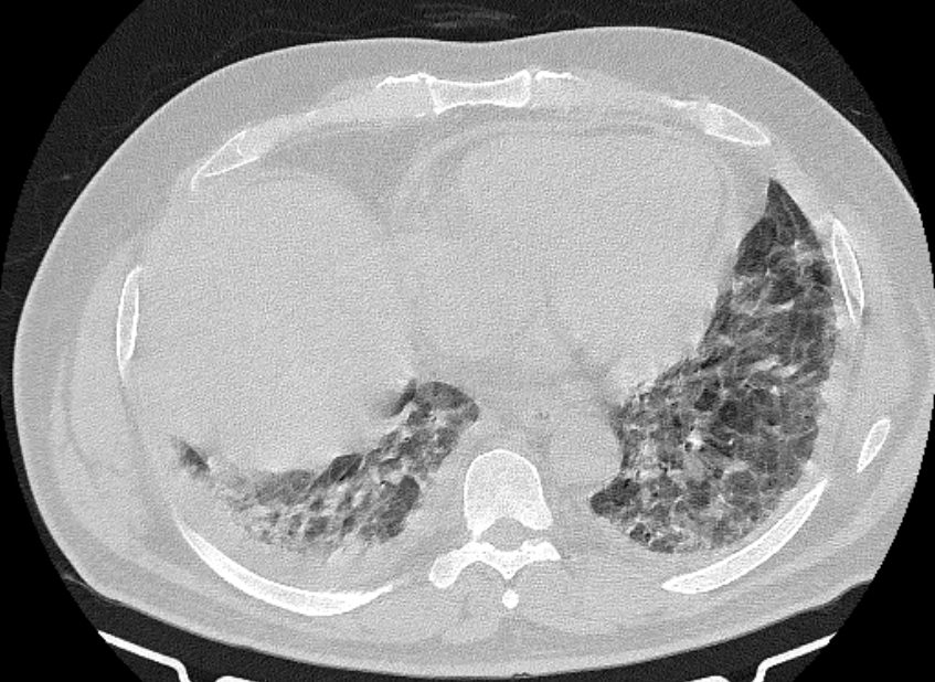 Cardiogenic pulmonary edema (Radiopaedia 68180-77678 Axial lung window 72).jpg