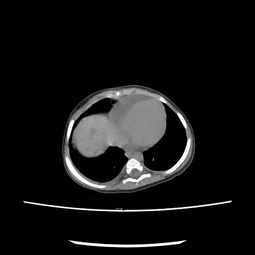 Caroli disease with autosomal recessive polycystic kidney disease (ARPKD) (Radiopaedia 89651-106703 E 10).jpg