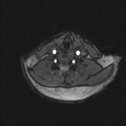 Carotid artery dissection (Radiopaedia 28441-28689 Axial MRA 28).jpg