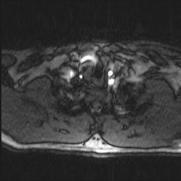 Carotid artery dissection (Radiopaedia 28441-28689 Axial MRA 8).jpg