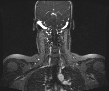 Carotid body tumor (Radiopaedia 12777-12912 MRA 47).jpg
