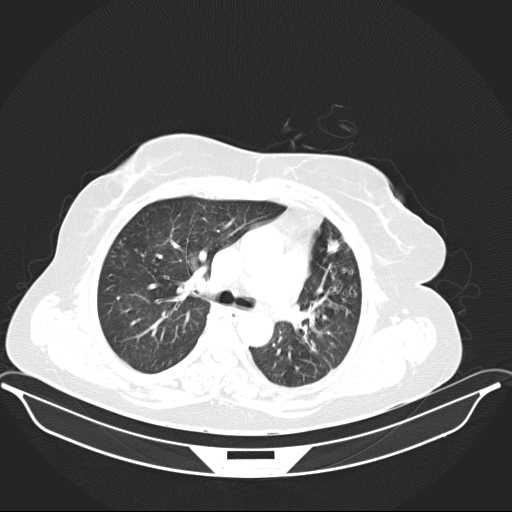 File:Carotid body tumor (Radiopaedia 21021-20948 Axial lung window 14).jpg
