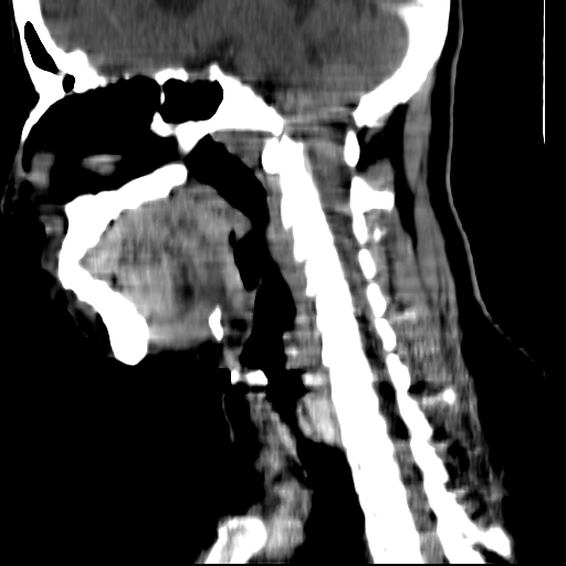 File:Carotid body tumor (Radiopaedia 27890-28124 C 12).jpg