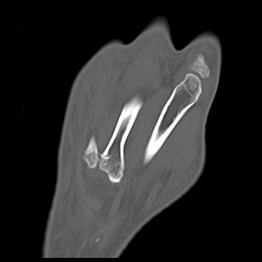 File:Carpo-metacarpal fracture-dislocations with hamatum split fracture (Radiopaedia 18482-18343 Coronal bone window 4).jpg