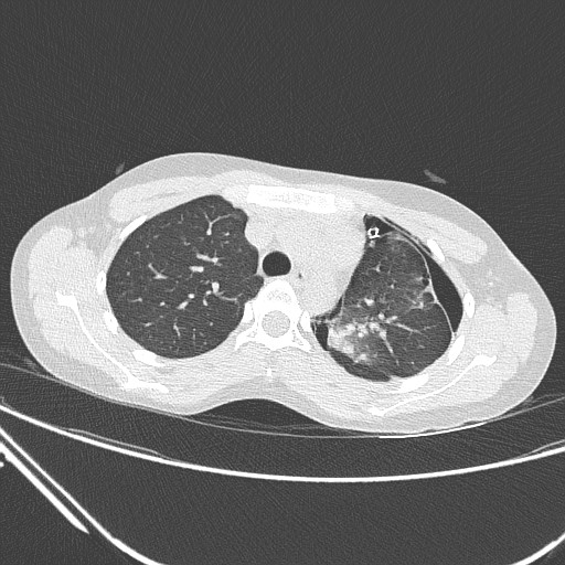 Catamenial pneumothorax (Radiopaedia 27946-28197 lung window 54).jpg