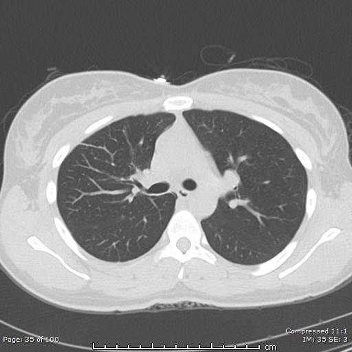 File:Catamenial pneumothorax (Radiopaedia 54382-60600 Axial non-contrast 35).jpg