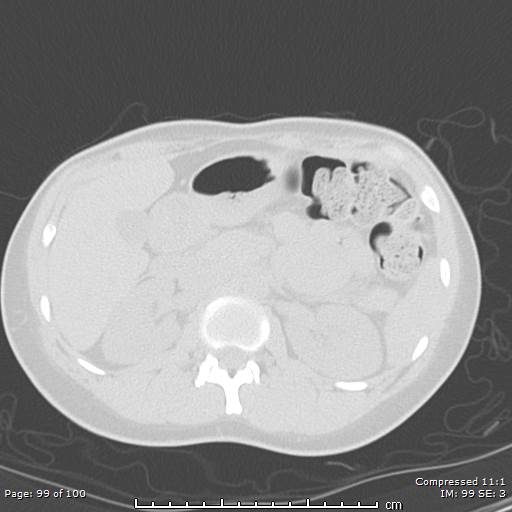 Catamenial pneumothorax (Radiopaedia 54382-60600 Axial non-contrast 99).jpg