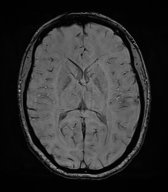 File:Cavernoma with bleed - midbrain (Radiopaedia 54546-60773 Axial SWI 26).png