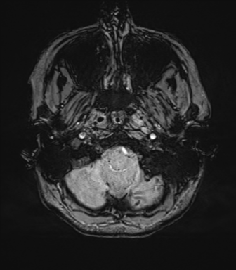 File:Cavernoma with bleed - midbrain (Radiopaedia 54546-60773 Axial SWI 7).png