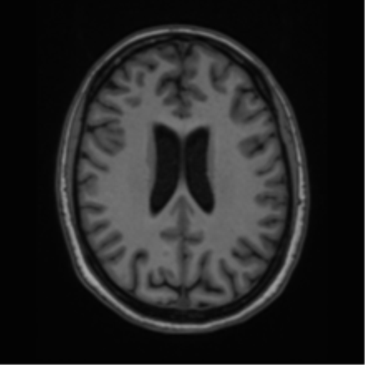 File:Cavernoma with bleed - midbrain (Radiopaedia 54546-60774 Axial T1 32).png