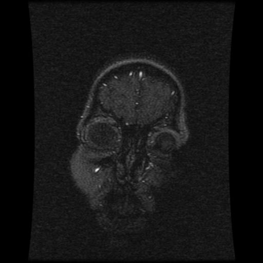 Cavernoma with developmental venous anomaly (Radiopaedia 22470-22507 MRV 115).jpg