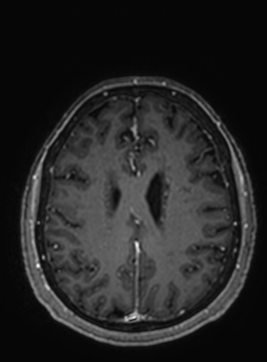 File:Cavernous hemangioma of the cerebellar falx (Radiopaedia 73025-83724 Axial T1 C+ 109).jpg