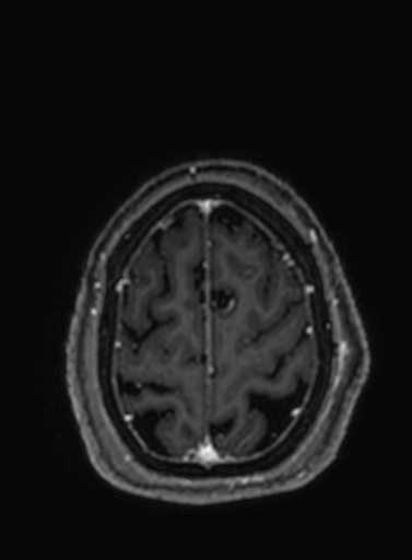 Cavernous hemangioma of the cerebellar falx (Radiopaedia 73025-83724 Axial T1 C+ 55).jpg