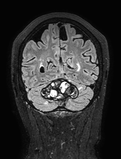 Cavernous hemangioma of the cerebellar falx (Radiopaedia 73025-83724 Coronal FLAIR 277).jpg