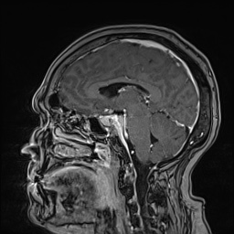 Cavernous sinus meningioma (Radiopaedia 63682-72367 Sagittal T1 C+ 97).jpg