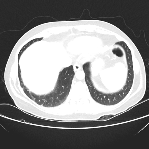 File:Cavitating lung mass - squamous cell carcinoma (Radiopaedia 48047-52854 Axial lung window 38).png