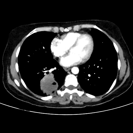 File:Cavitating lung mass - squamous cell carcinoma (Radiopaedia 48047-52854 B 31).png