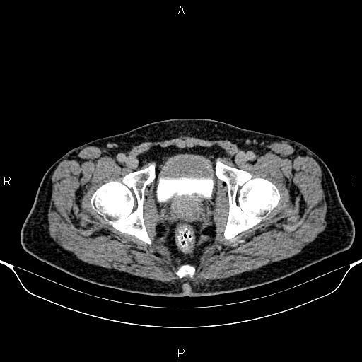 Cecal adenocarcinoma (Radiopaedia 85324-100916 Axial C+ delayed 97).jpg
