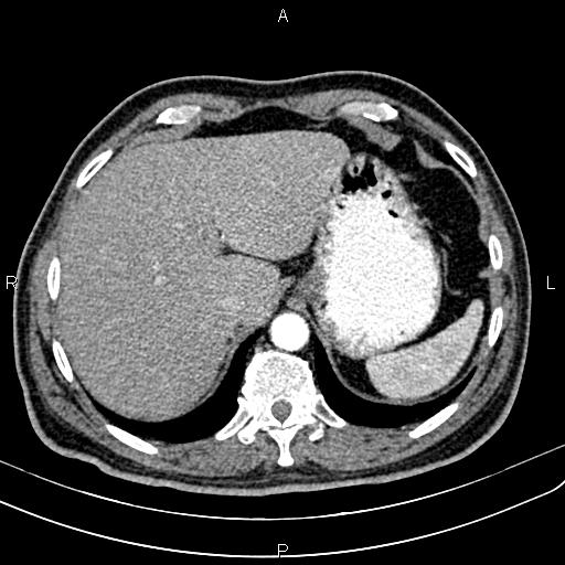 Cecal cancer with appendiceal mucocele (Radiopaedia 91080-108651 A 59).jpg