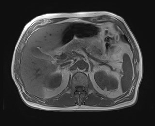 File:Cecal mass causing appendicitis (Radiopaedia 59207-66532 Axial T1 in-phase 44).jpg