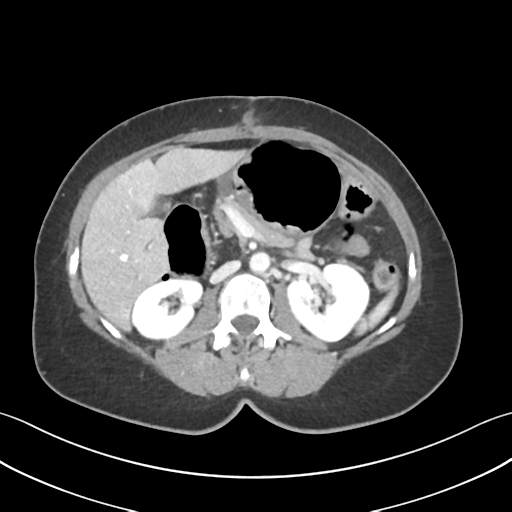 Cecum hernia through the foramen of Winslow (Radiopaedia 46634-51112 A 28).png