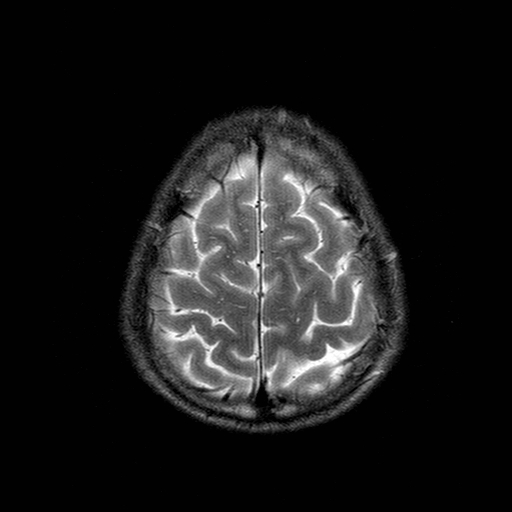 File:Central-variant posterior reversible encephalopathy syndrome (PRES) (Radiopaedia 43880-47359 Axial T2 21).jpg