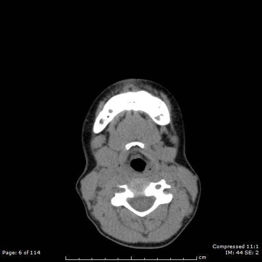 File:Central giant cell granuloma (Radiopaedia 45612-49754 Axial non-contrast 3).jpg