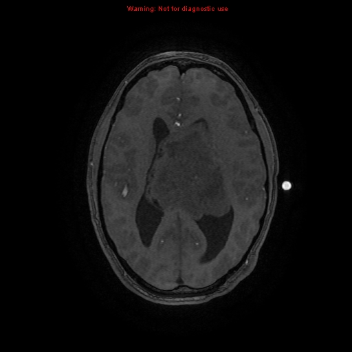 File:Central neurocytoma (Radiopaedia 13188-13206 Axial MRA 20).jpg