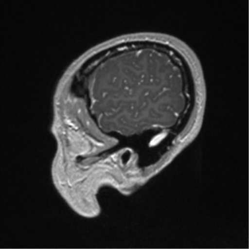 Central neurocytoma (Radiopaedia 37664-39557 Sagittal T1 C+ 15).png