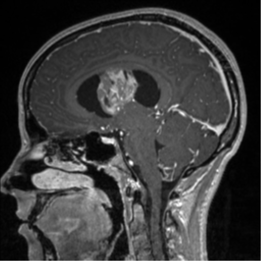 File:Central neurocytoma (Radiopaedia 37664-39557 Sagittal T1 C+ 47).png