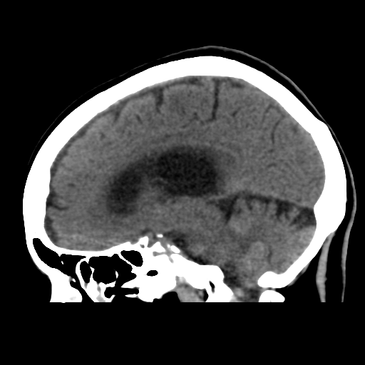 File:Central neurocytoma (Radiopaedia 65317-74346 C 25).png