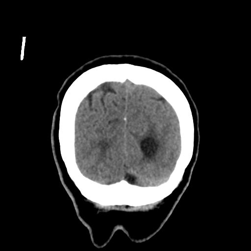 File:Central neurocytoma (Radiopaedia 65317-74346 Coronal non-contrast 54).png