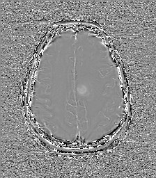 Central neurocytoma (Radiopaedia 84497-99872 Axial 54).jpg