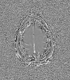 Central neurocytoma (Radiopaedia 84497-99872 Axial 64).jpg