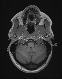 Central neurocytoma (Radiopaedia 84497-99872 Axial T1 41).jpg