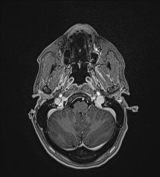 Central neurocytoma (Radiopaedia 84497-99872 Axial T1 C+ 27).jpg