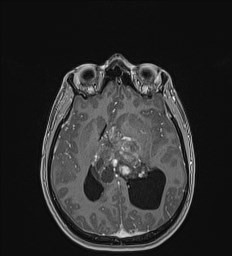 Central neurocytoma (Radiopaedia 84497-99872 Axial T1 C+ 84).jpg