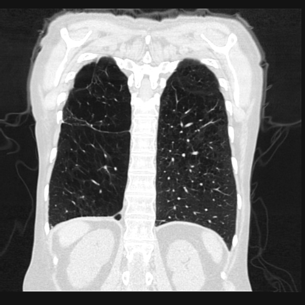 Centrilobular pulmonary emphysema (Radiopaedia 24495-24789 Coronal lung window 60).jpg