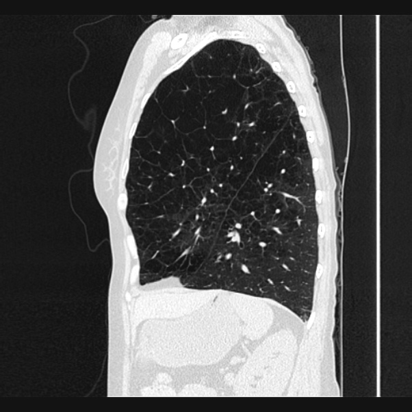 Centrilobular pulmonary emphysema (Radiopaedia 24495-24789 Sagittal lung window 62).jpg