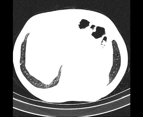 Centrilobular pulmonary emphysema (Radiopaedia 62468-70718 Axial lung window 71).jpg